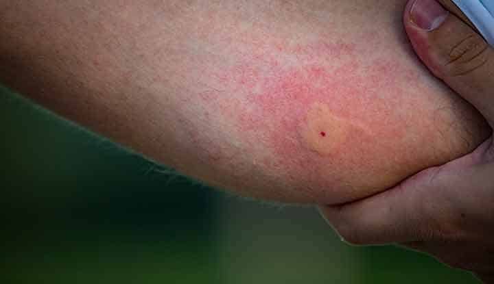 What Bit Me? Spot These 13 Bug Bites