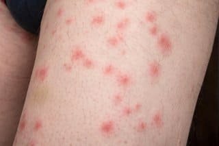 What Bit Me? Spot These 13 Bug Bites