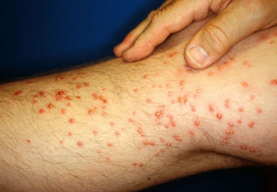 What Bit Me? Spot These 13 Bug Bites