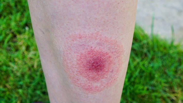 What Bit Me? Spot These 13 Bug Bites