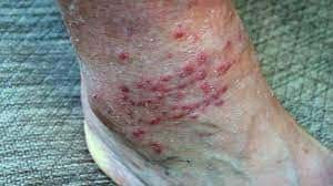 What Bit Me? Spot These 13 Bug Bites