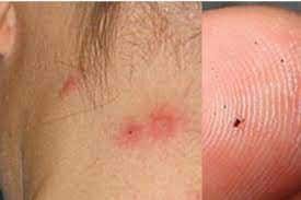 What Bit Me? Spot These 13 Bug Bites 