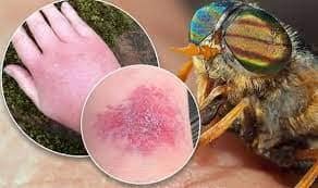 What Bit Me? Spot These 13 Bug Bites