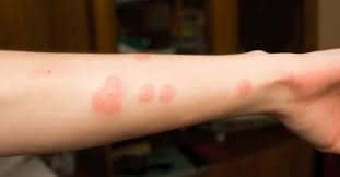 What Bit Me? Spot These 13 Bug Bites