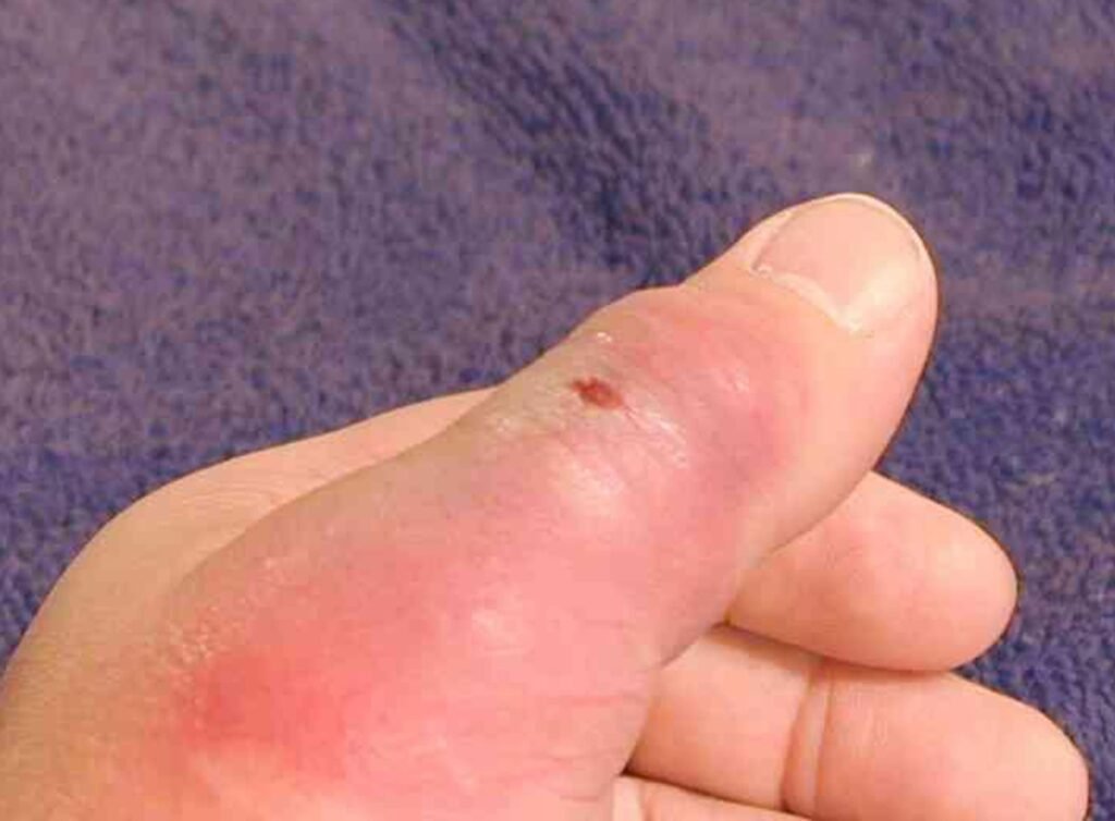 What Bit Me? Spot These 13 Bug Bites