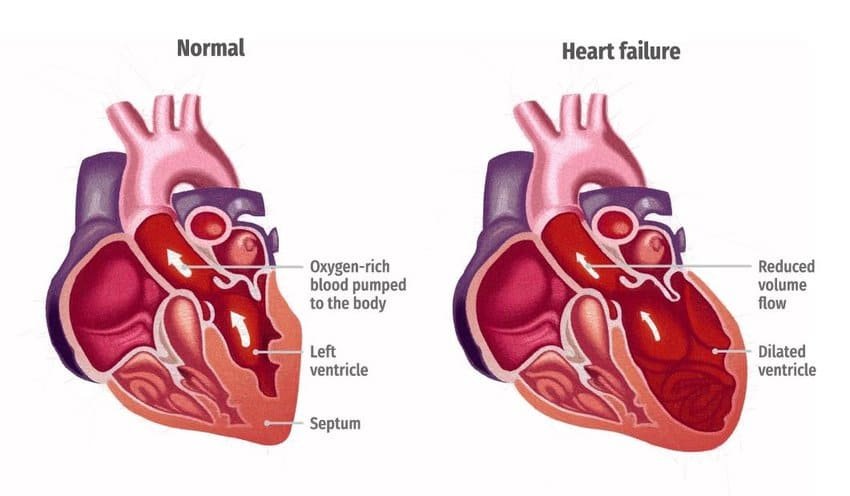 congestive heart failure