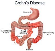 Crohn's disease